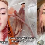 GROSS: Transgender TikToker Spends $17,000 to Remove Six of His Ribs — Plans to Make Them Into a Crown (VIDEO)