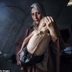 The photo of the toddler who became a symbol of hunger in Gaza: Investigation shows he suffers from genetic disease