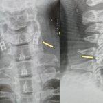 World’s first spinal cord transplant to take place in Israel, could allow patients to walk again