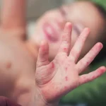 Health Ministry: 1,880 confirmed measles cases – thousands unreported