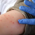 Petah Tikva joins list of measles outbreak hotspots