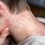 Petah Tikva declared ‘red city’ for measles outbreak, six-month-old children to be vaccinated