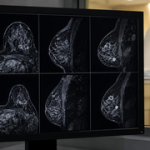AI breakthrough could make breast cancer MRI scans faster, sharper and more accessible